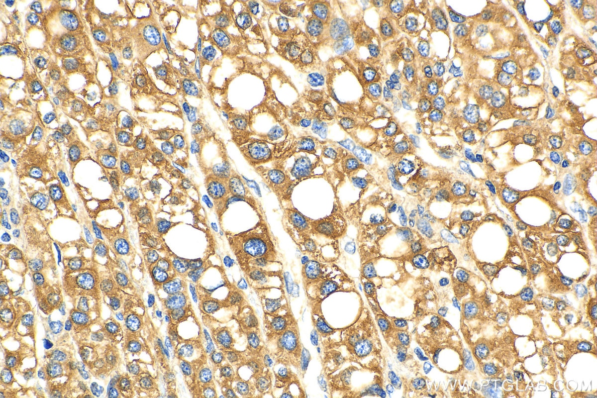 IHC staining of human liver cancer using 11059-1-AP