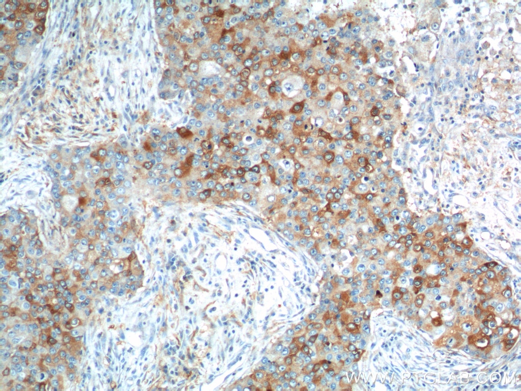 Immunohistochemistry (IHC) staining of human breast cancer tissue using IL-13RA2 Polyclonal antibody (11059-1-AP)