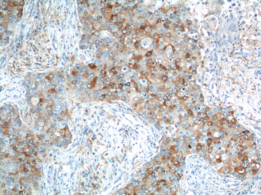 IHC staining of human breast cancer using 11059-1-AP