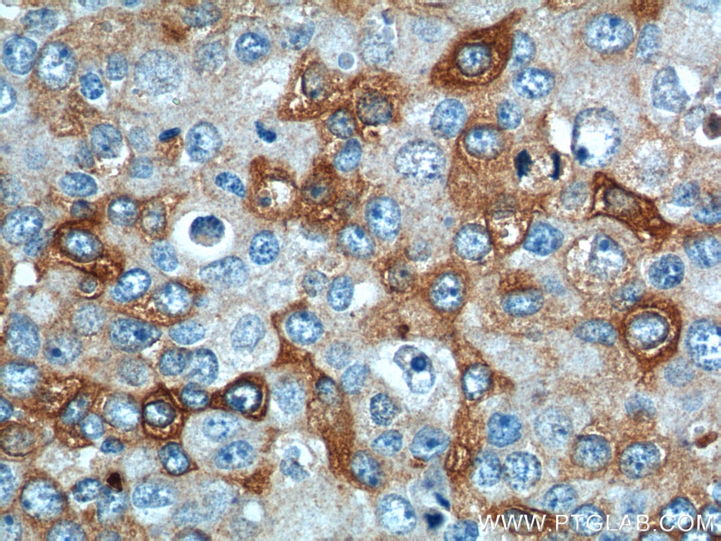 Immunohistochemistry (IHC) staining of human breast cancer tissue using IL-13RA2 Polyclonal antibody (11059-1-AP)