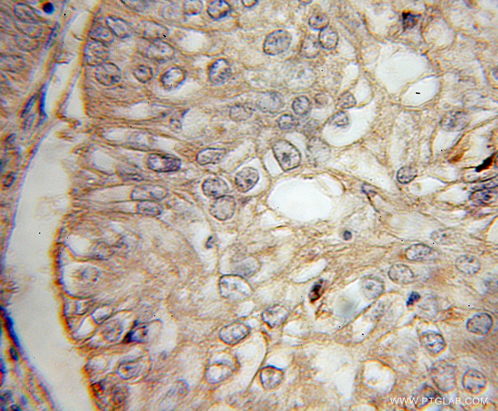 Immunohistochemistry (IHC) staining of human ovary tumor tissue using IL-13RA2 Polyclonal antibody (11059-1-AP)
