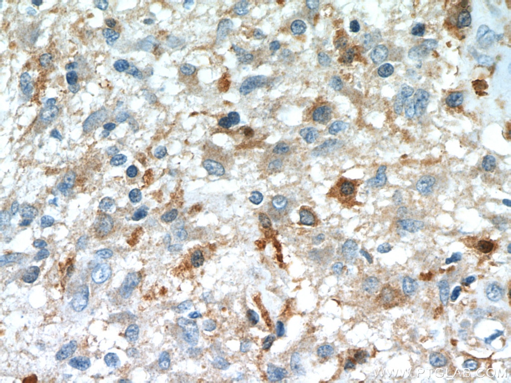 Immunohistochemistry (IHC) staining of human gliomas tissue using IL-13RA2 Polyclonal antibody (11059-1-AP)