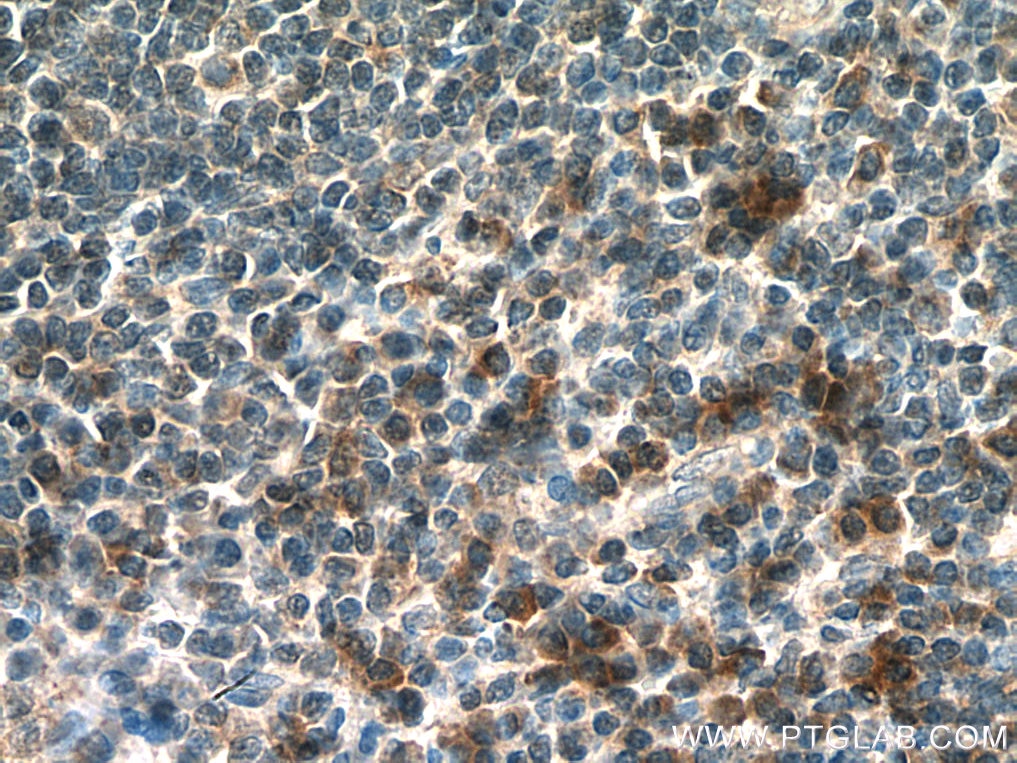 Immunohistochemistry (IHC) staining of human tonsillitis tissue using IL-15 Polyclonal antibody (28455-1-AP)