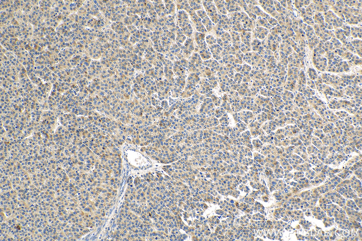 Immunohistochemistry (IHC) staining of human liver cancer tissue using IL-15RA Polyclonal antibody (16744-1-AP)