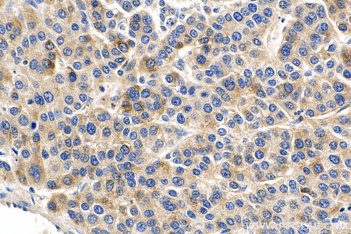 Immunohistochemistry (IHC) staining of human liver cancer tissue using IL-15RA Polyclonal antibody (16744-1-AP)