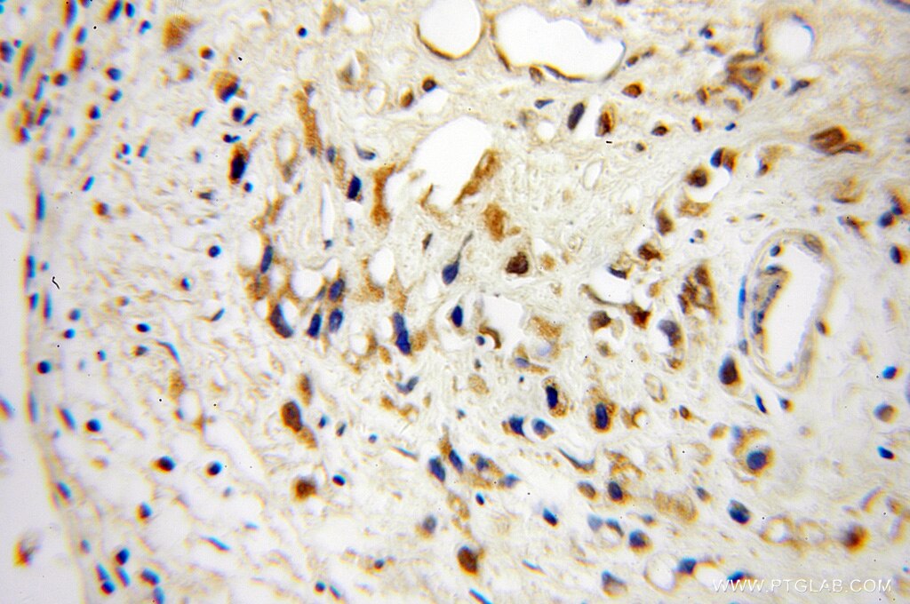 Immunohistochemistry (IHC) staining of human prostate cancer tissue using IL-16 Polyclonal antibody (13352-1-AP)