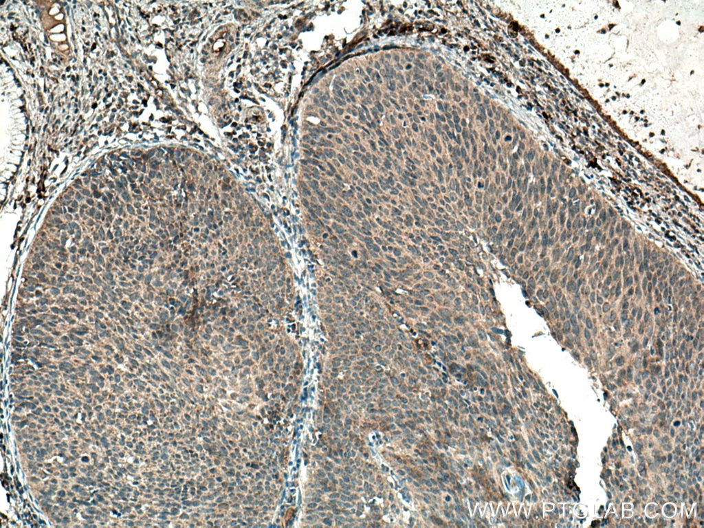 Immunohistochemistry (IHC) staining of human cervical cancer tissue using IL-17A Polyclonal antibody (13082-1-AP)