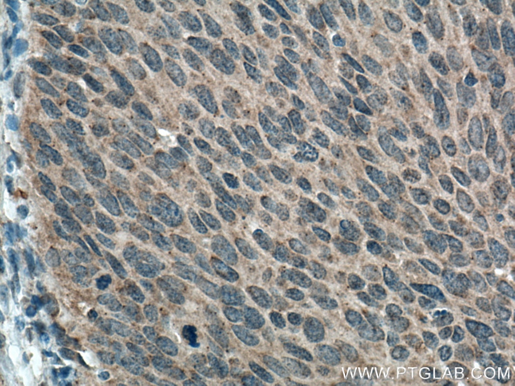 Immunohistochemistry (IHC) staining of human cervical cancer tissue using IL-17 Polyclonal antibody (13082-1-AP)