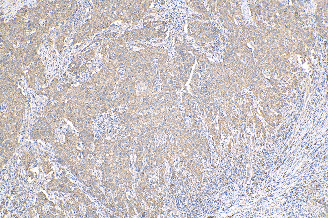 IHC staining of human stomach cancer using 13082-1-AP