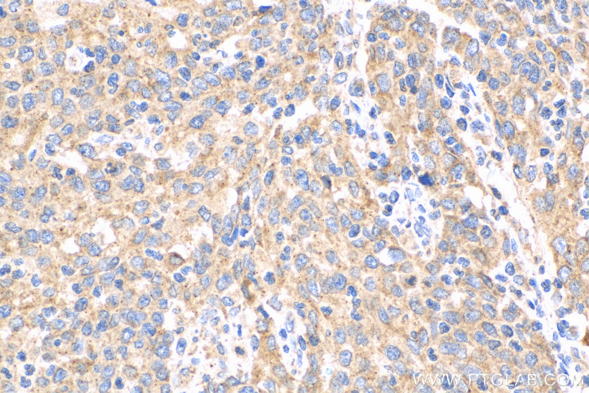 Immunohistochemistry (IHC) staining of human stomach cancer tissue using IL-17 Polyclonal antibody (13082-1-AP)