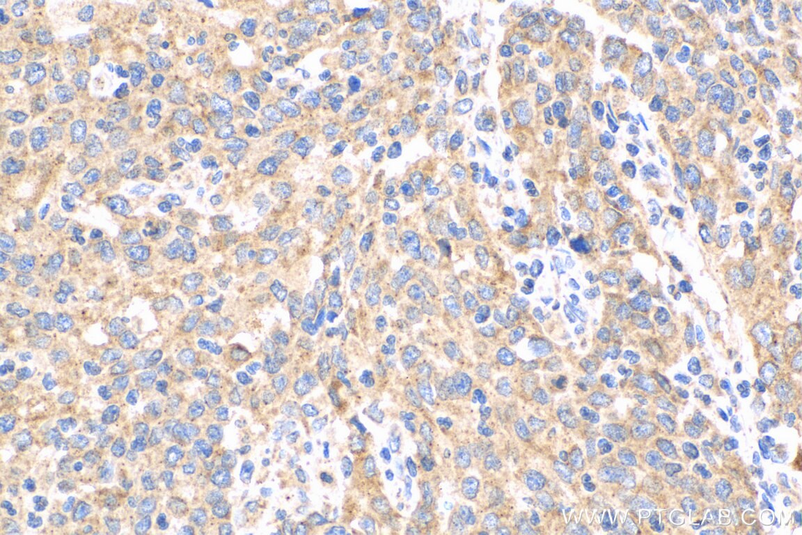 Immunohistochemistry (IHC) staining of human stomach cancer tissue using IL-17A Polyclonal antibody (13082-1-AP)