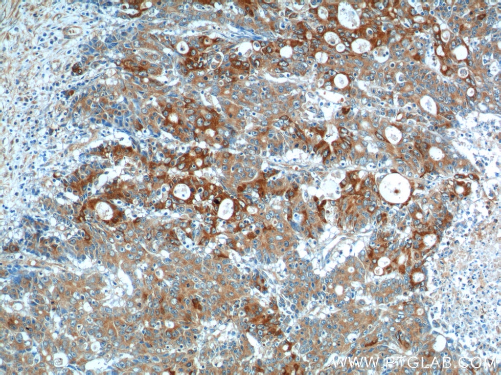 Immunohistochemistry (IHC) staining of human colon cancer tissue using IL-17A Polyclonal antibody (13082-1-AP)