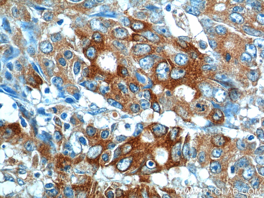 Immunohistochemistry (IHC) staining of human colon cancer tissue using IL-17 Polyclonal antibody (13082-1-AP)