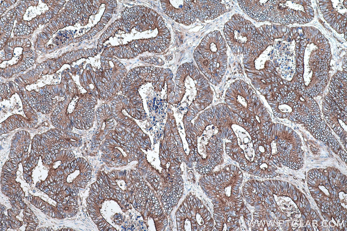 Immunohistochemistry (IHC) staining of human colon cancer tissue using IL-17 Monoclonal antibody (66148-1-Ig)