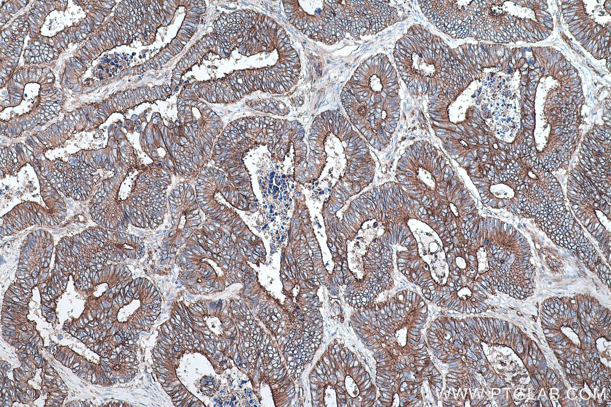 IHC staining of human colon cancer using 66148-1-Ig