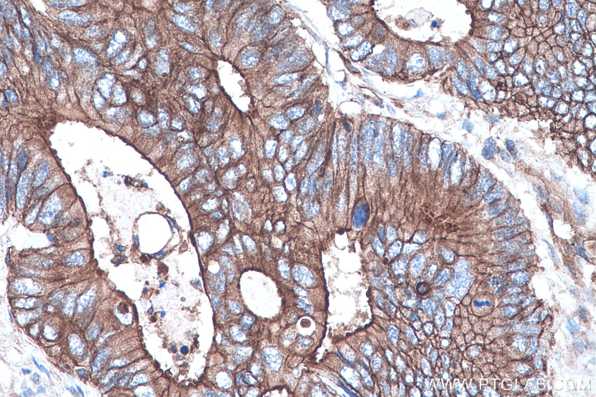 Immunohistochemistry (IHC) staining of human colon cancer tissue using IL-17 Monoclonal antibody (66148-1-Ig)