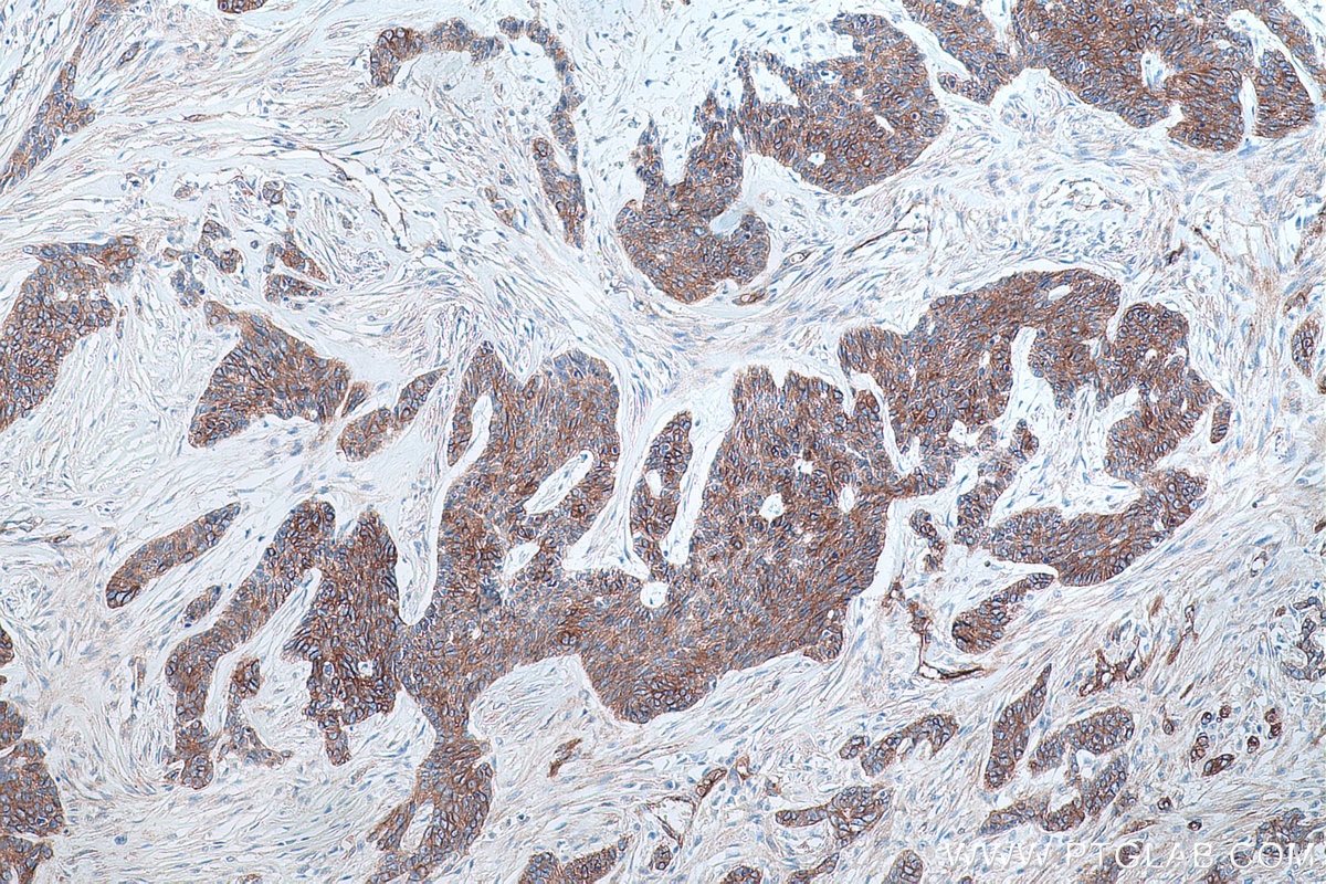 Immunohistochemistry (IHC) staining of human skin cancer tissue using IL-17A Monoclonal antibody (66148-1-Ig)