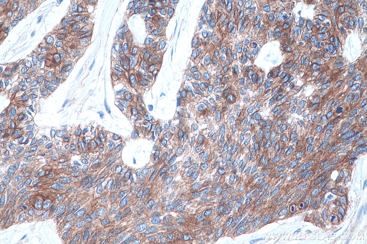 Immunohistochemistry (IHC) staining of human skin cancer tissue using IL-17A Monoclonal antibody (66148-1-Ig)