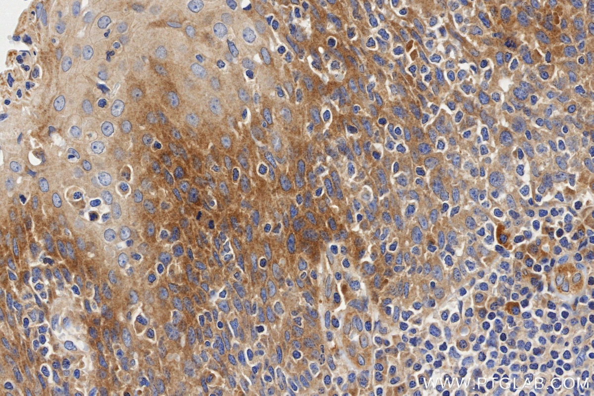 Immunohistochemistry (IHC) staining of Human Tonsil tissue using IL-17RA Recombinant monoclonal antibody (84535-2-RR)