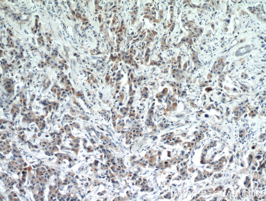 Immunohistochemistry (IHC) staining of human breast cancer tissue using IL-17RB Polyclonal antibody (20673-1-AP)