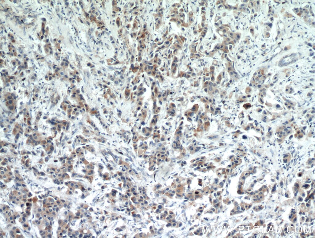 Immunohistochemistry (IHC) staining of human breast cancer tissue using IL-17RB Polyclonal antibody (20673-1-AP)