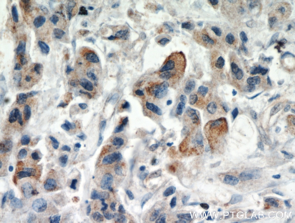 Immunohistochemistry (IHC) staining of human breast cancer tissue using IL-17RB Polyclonal antibody (20673-1-AP)
