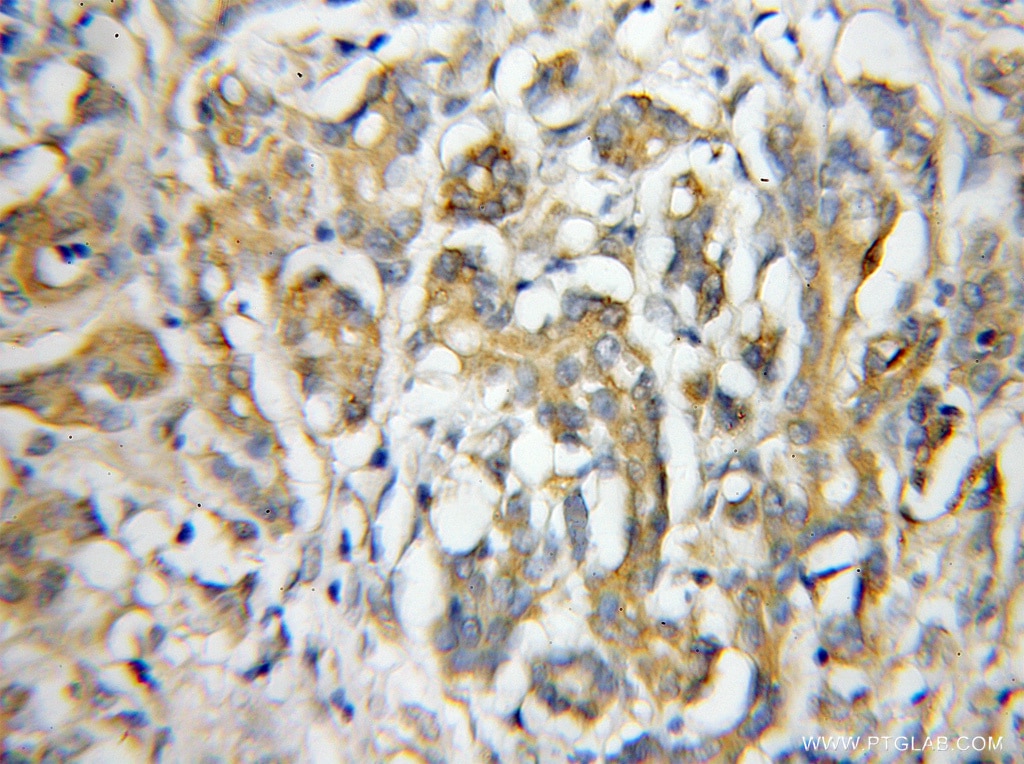 Immunohistochemistry (IHC) staining of human pancreas cancer tissue using IL-17RE Polyclonal antibody (11984-1-AP)