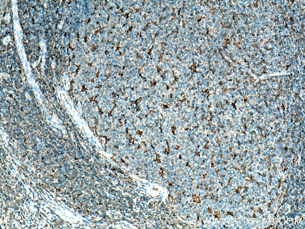 Immunohistochemistry (IHC) staining of human tonsillitis tissue using IL-18 Polyclonal antibody (10663-1-AP)