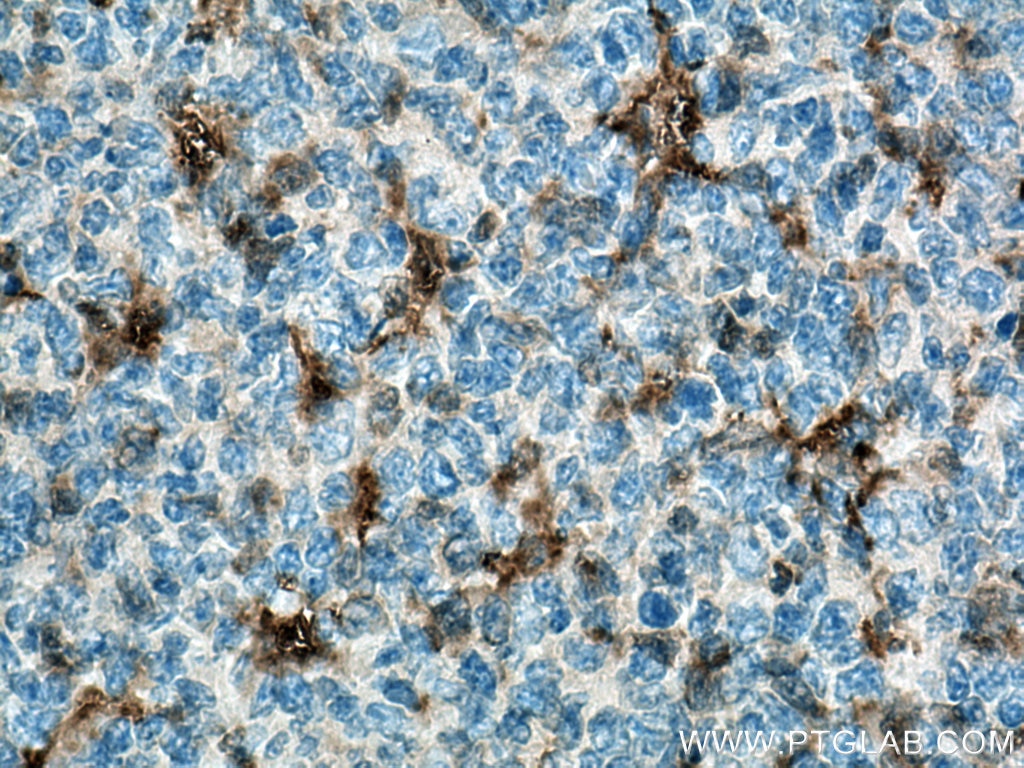 Immunohistochemistry (IHC) staining of human tonsillitis tissue using IL-18 Polyclonal antibody (10663-1-AP)