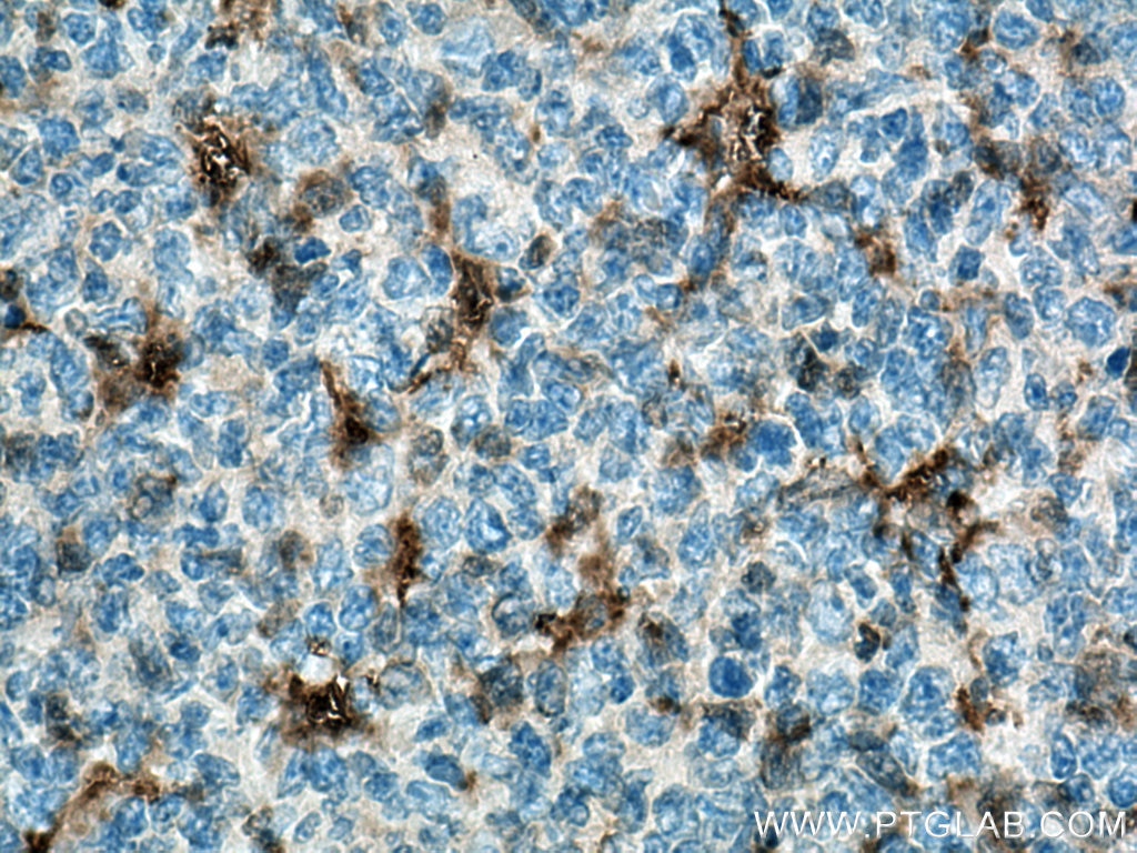 IHC staining of human tonsillitis using 10663-1-AP