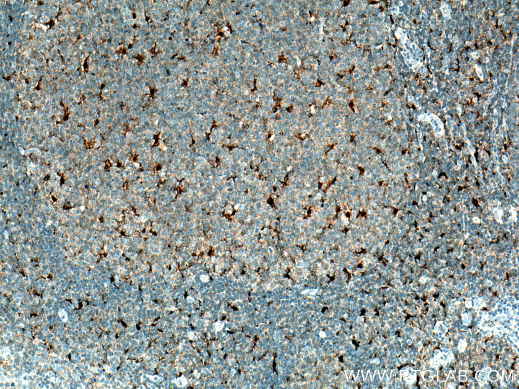 Immunohistochemistry (IHC) staining of human tonsillitis tissue using IL-18 Monoclonal antibody (60070-1-Ig)