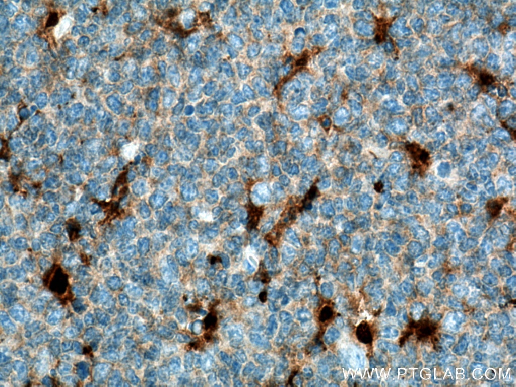 IHC staining of human tonsillitis using 60070-1-Ig