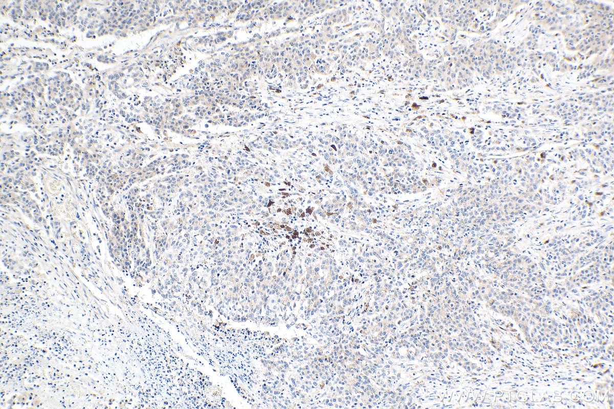 Immunohistochemistry (IHC) staining of human stomach cancer tissue using IL-18 Monoclonal antibody (60070-1-Ig)