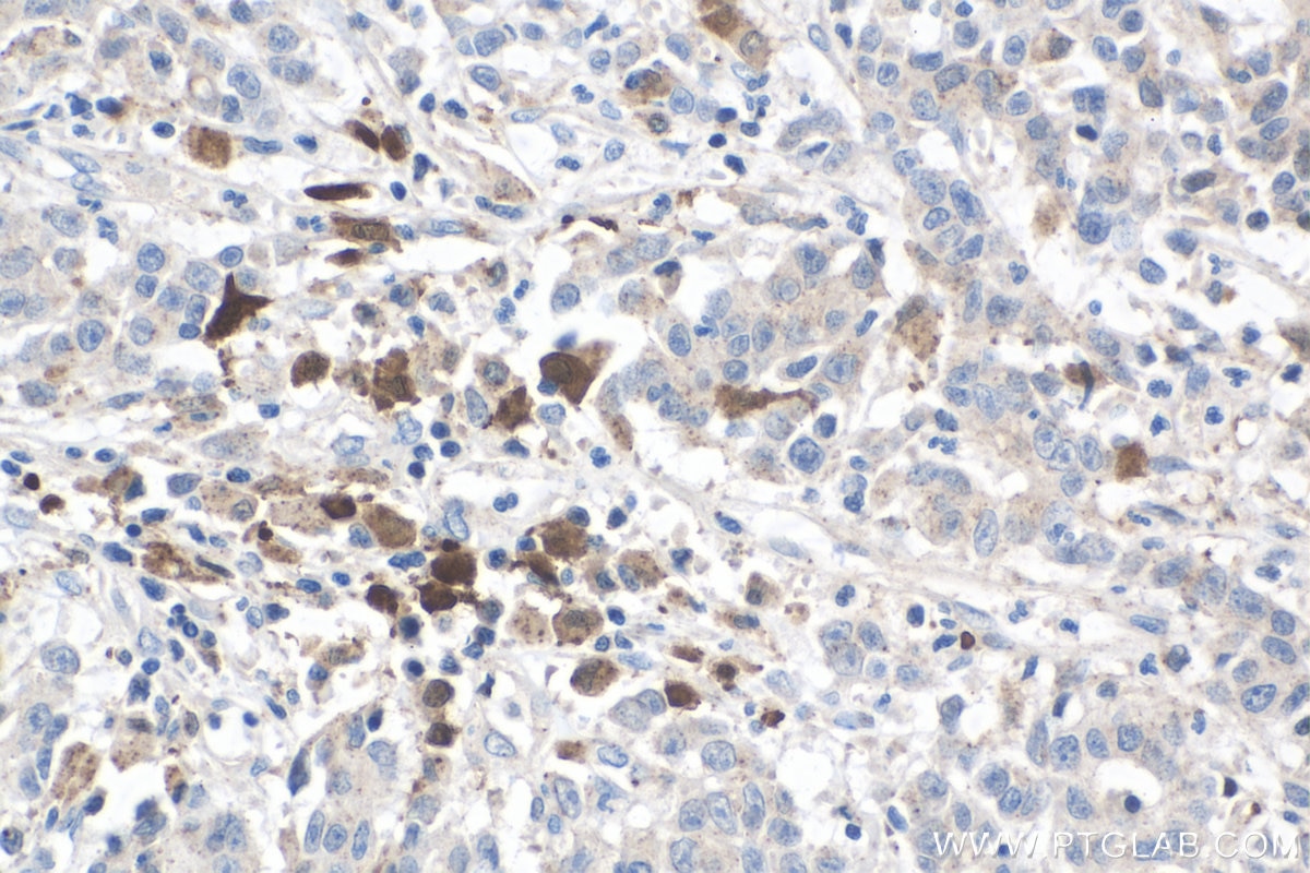 IHC staining of human stomach cancer using 60070-1-Ig