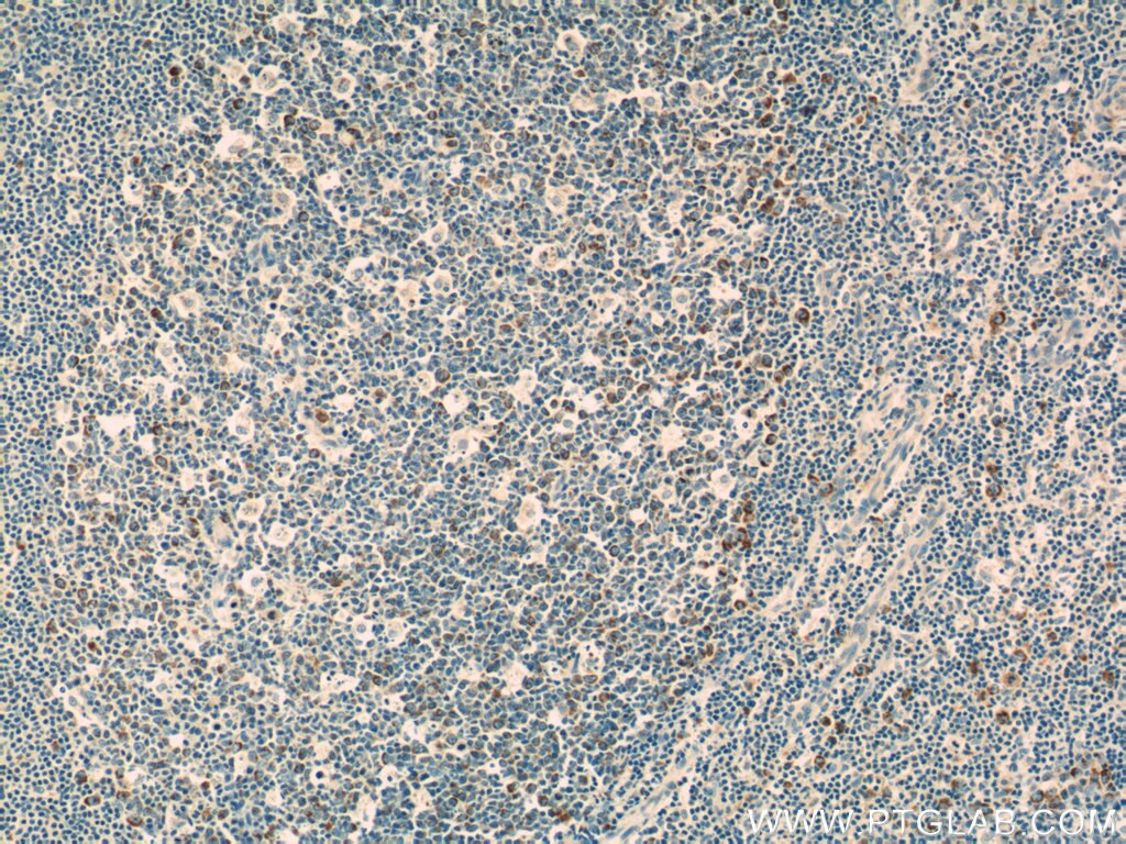 Immunohistochemistry (IHC) staining of human tonsillitis tissue using IL-19 Monoclonal antibody (60278-1-Ig)