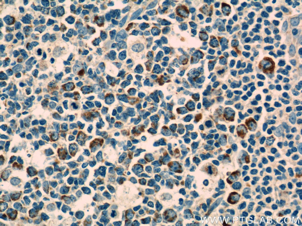Immunohistochemistry (IHC) staining of human tonsillitis tissue using IL-19 Monoclonal antibody (60278-1-Ig)