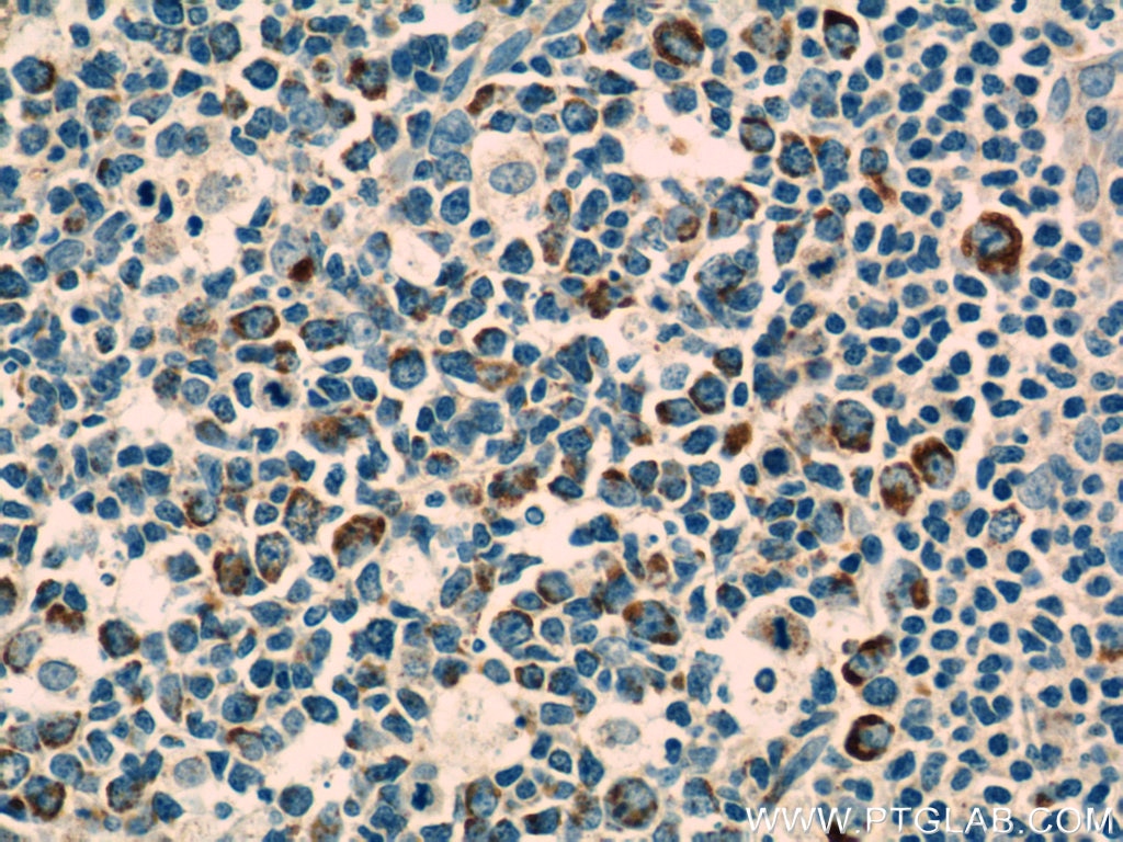 IHC staining of human tonsillitis using 60278-1-Ig