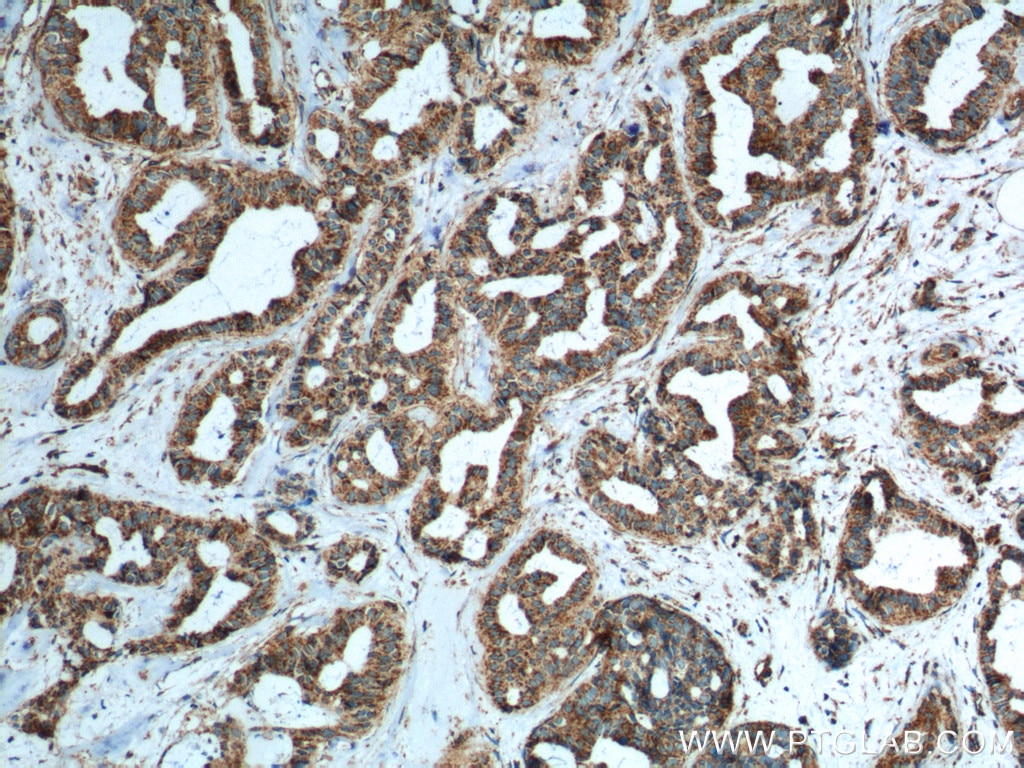 IHC staining of human breast cancer using 60278-1-Ig