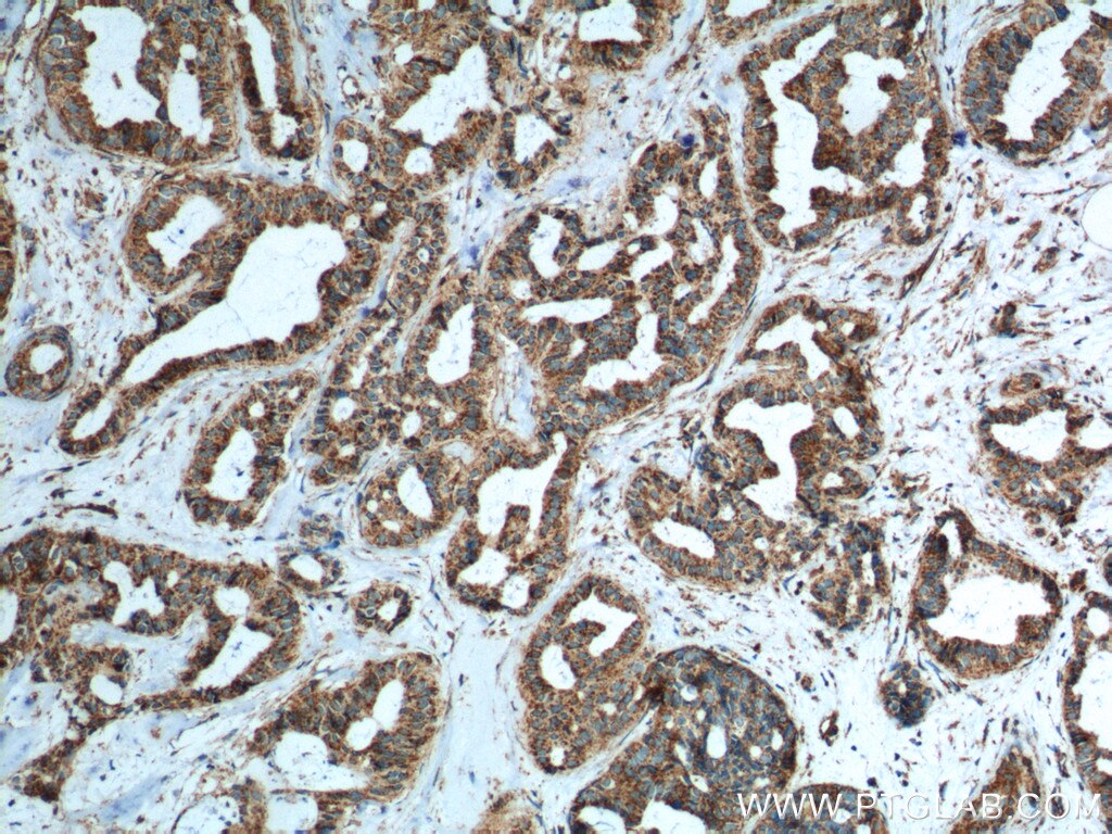 Immunohistochemistry (IHC) staining of human breast cancer tissue using IL-19 Monoclonal antibody (60278-1-Ig)