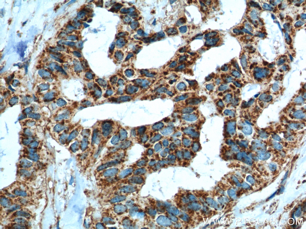 Immunohistochemistry (IHC) staining of human breast cancer tissue using IL-19 Monoclonal antibody (60278-1-Ig)
