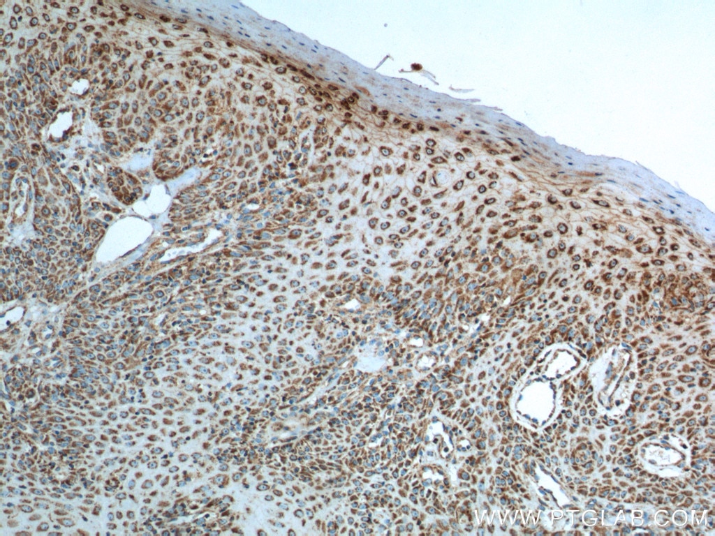 Immunohistochemistry (IHC) staining of human skin cancer tissue using IL-19 Monoclonal antibody (60278-1-Ig)