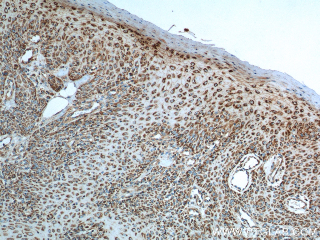 IHC staining of human skin cancer using 60278-1-Ig