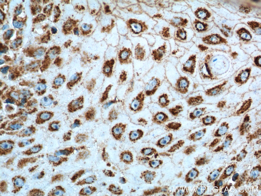 Immunohistochemistry (IHC) staining of human skin cancer tissue using IL-19 Monoclonal antibody (60278-1-Ig)