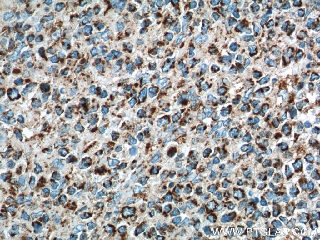 Immunohistochemistry (IHC) staining of human tonsillitis tissue using IL-19 Monoclonal antibody (60278-1-Ig)