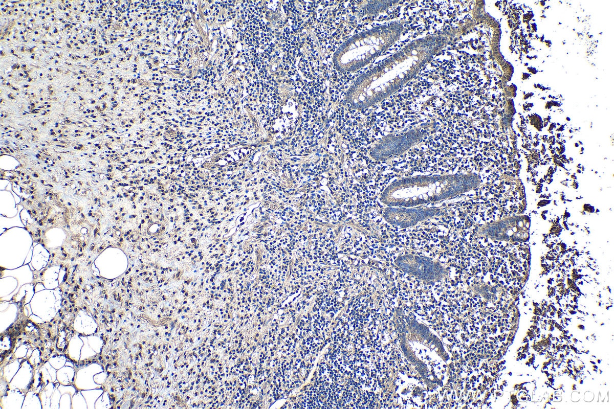 Immunohistochemistry (IHC) staining of human appendicitis tissue using IL-1 Alpha Polyclonal antibody (16765-1-AP)