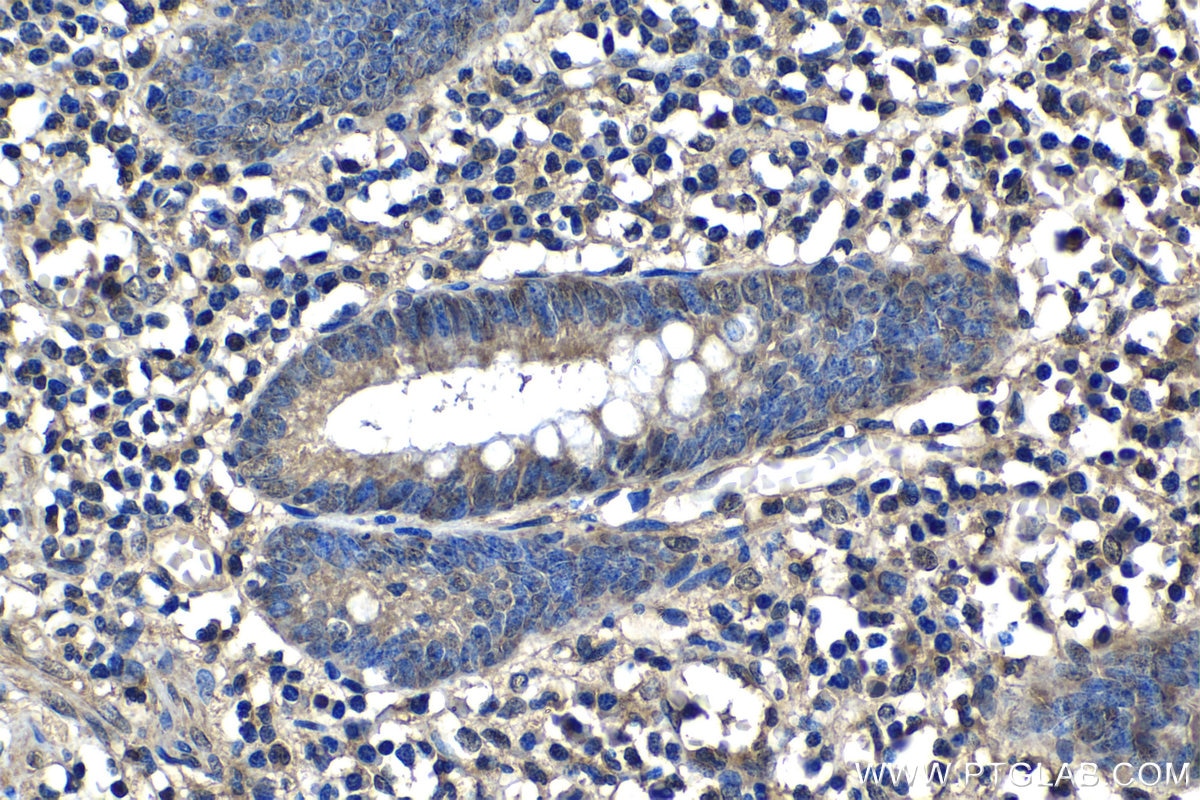 Immunohistochemistry (IHC) staining of human appendicitis tissue using IL-1 Alpha Polyclonal antibody (16765-1-AP)