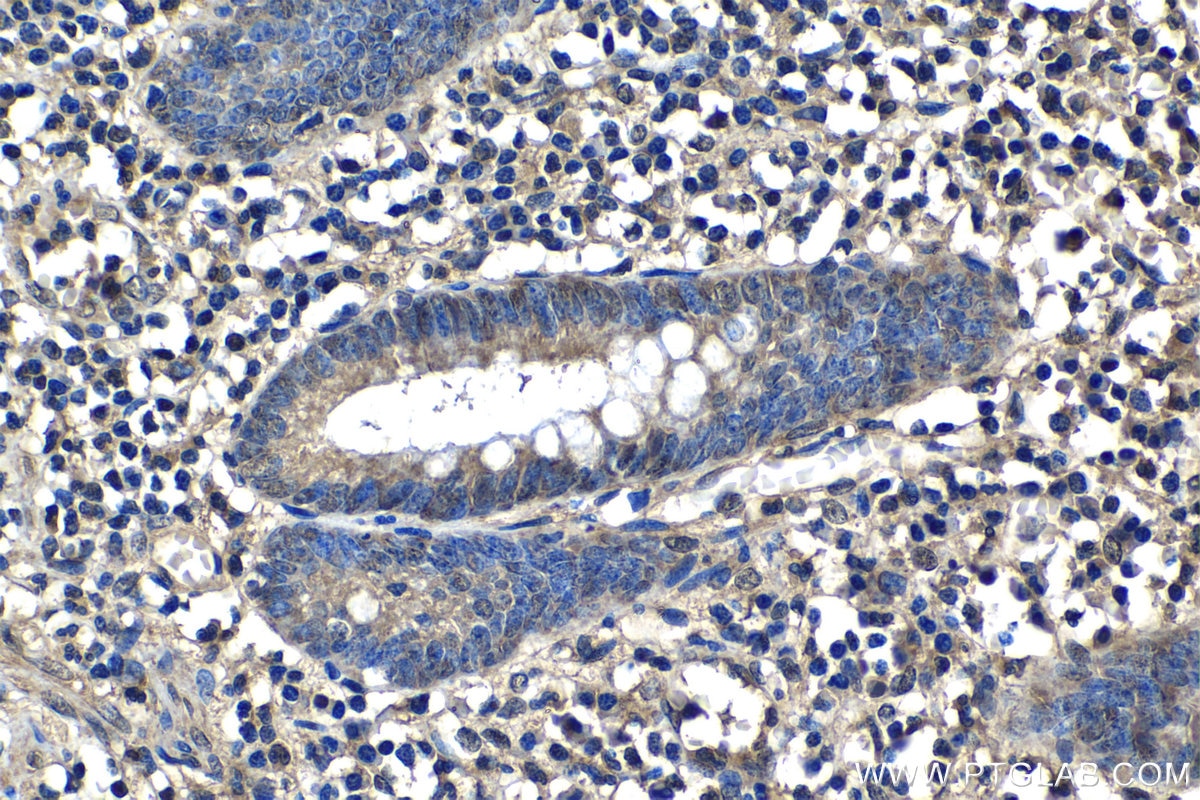 IHC staining of human appendicitis using 16765-1-AP