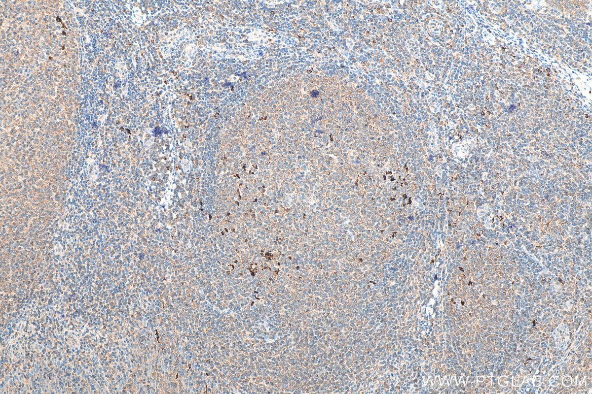 Immunohistochemistry (IHC) staining of human tonsillitis tissue using IL-1 Beta Polyclonal antibody (16806-1-AP)