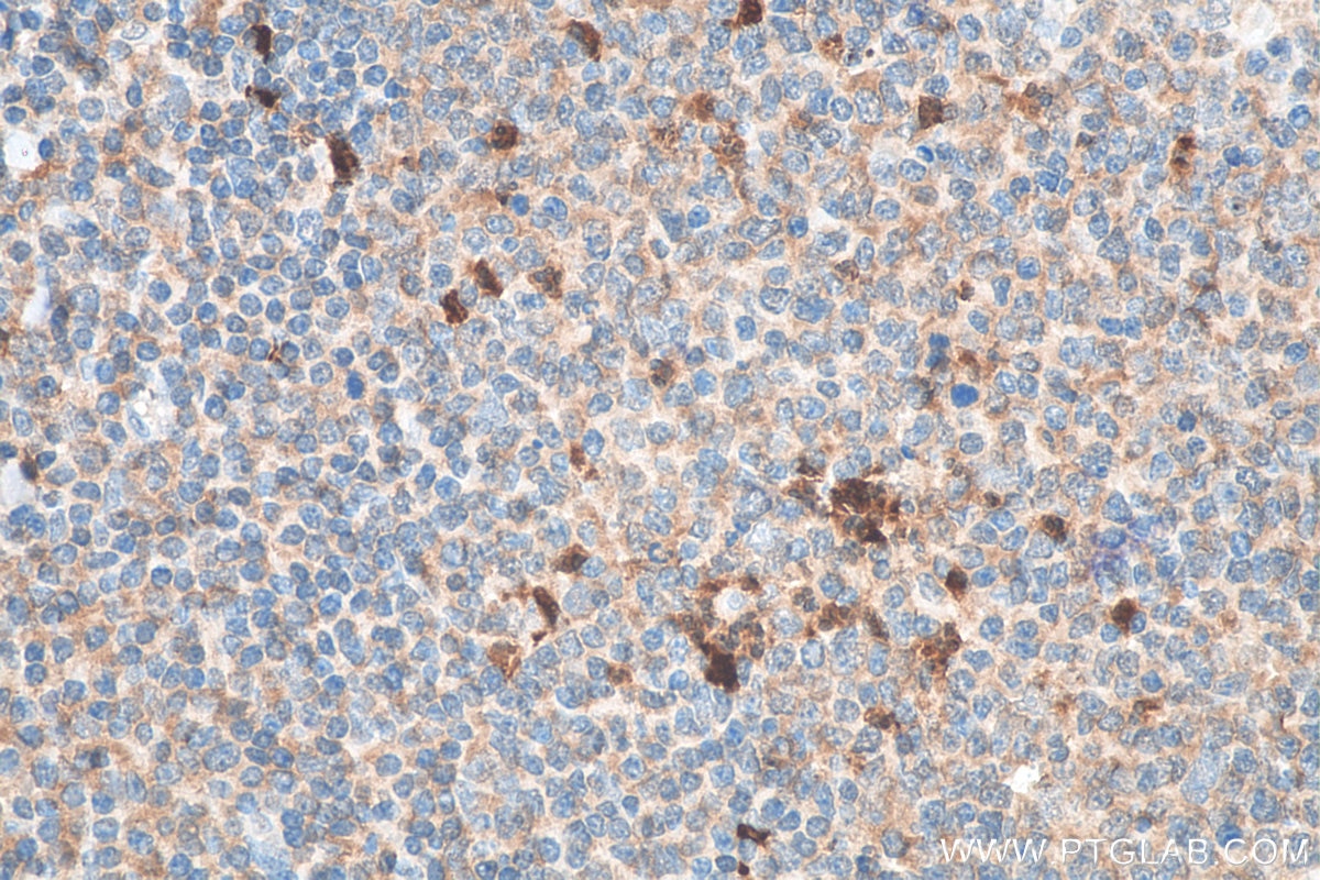 IHC staining of human tonsillitis using 16806-1-AP