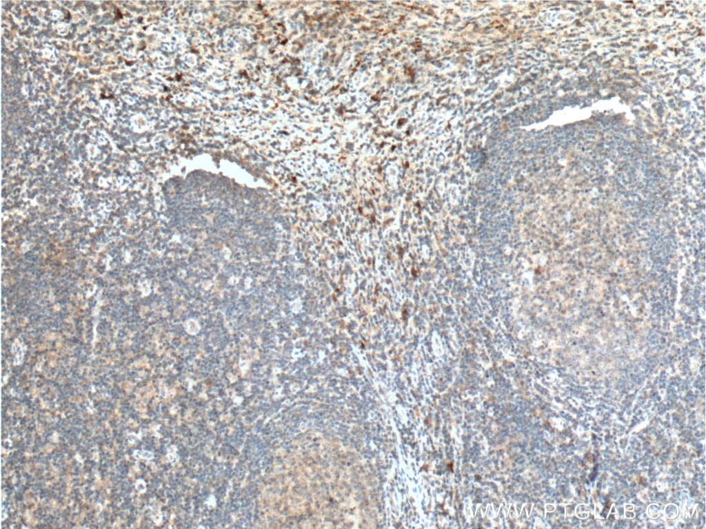 Immunohistochemistry (IHC) staining of human tonsillitis tissue using IL-1 Beta Polyclonal antibody (16806-1-AP)